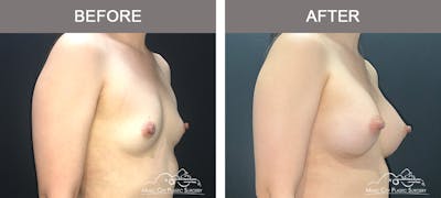 Breast Augmentation Before & After Gallery - Patient 195592422 - Image 2