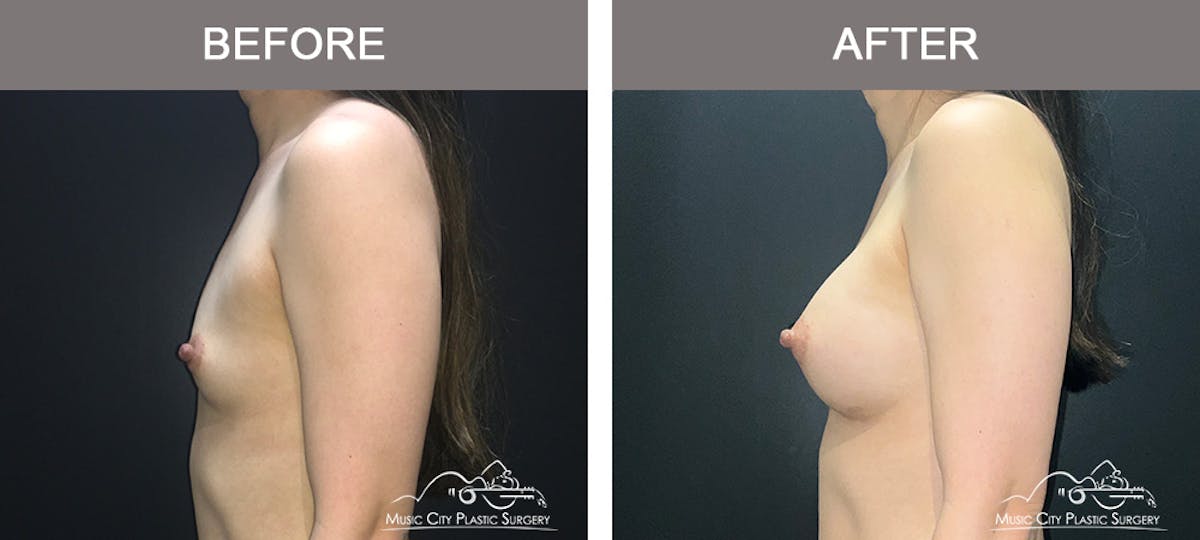 Breast Augmentation Before & After Gallery - Patient 195592422 - Image 5