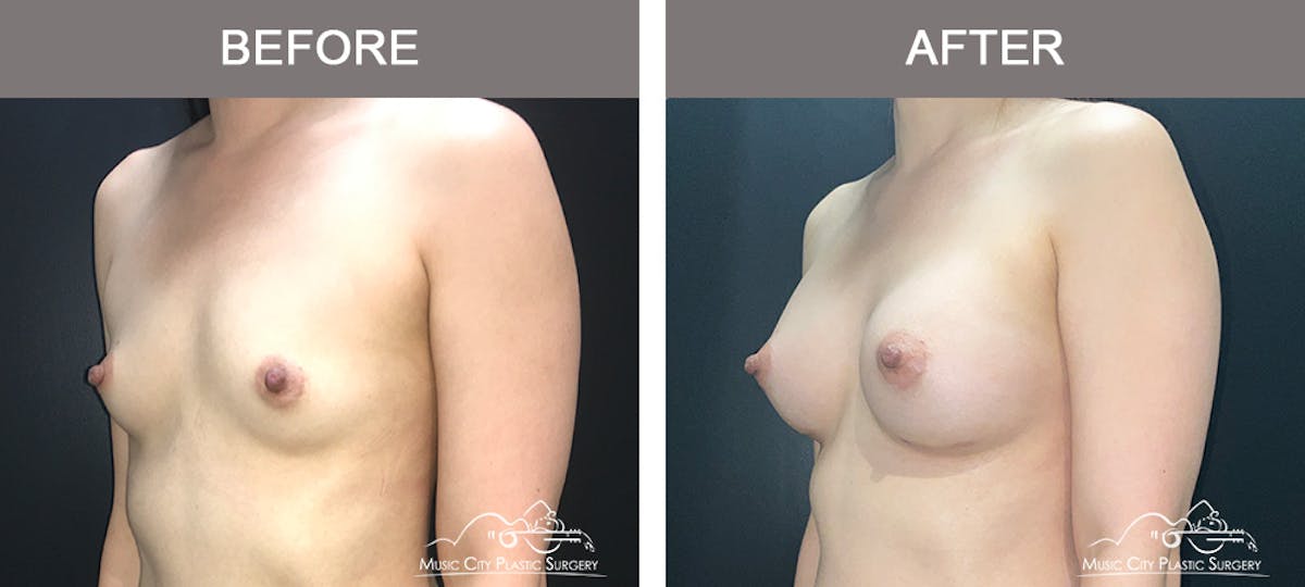 Breast Augmentation Before & After Gallery - Patient 195592422 - Image 4