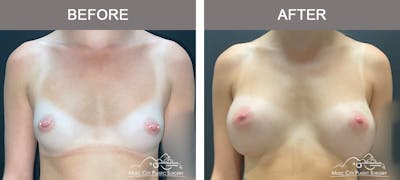 Breast Augmentation Before & After Gallery - Patient 195592423 - Image 1