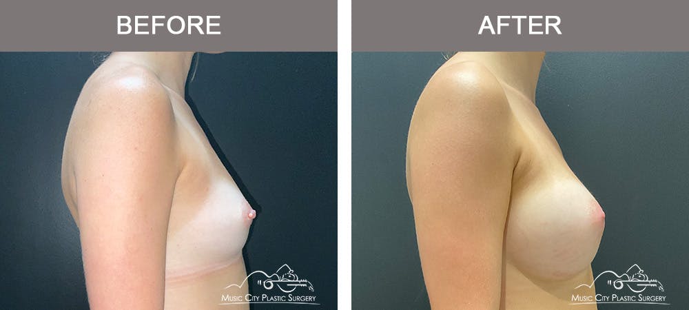 Breast Augmentation Before & After Gallery - Patient 195592423 - Image 3