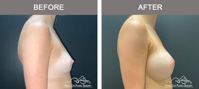 Breast Augmentation Before & After Gallery - Patient 195592423 - Image 3