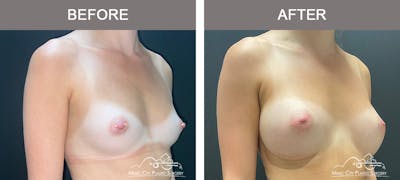 Breast Augmentation Before & After Gallery - Patient 195592423 - Image 2