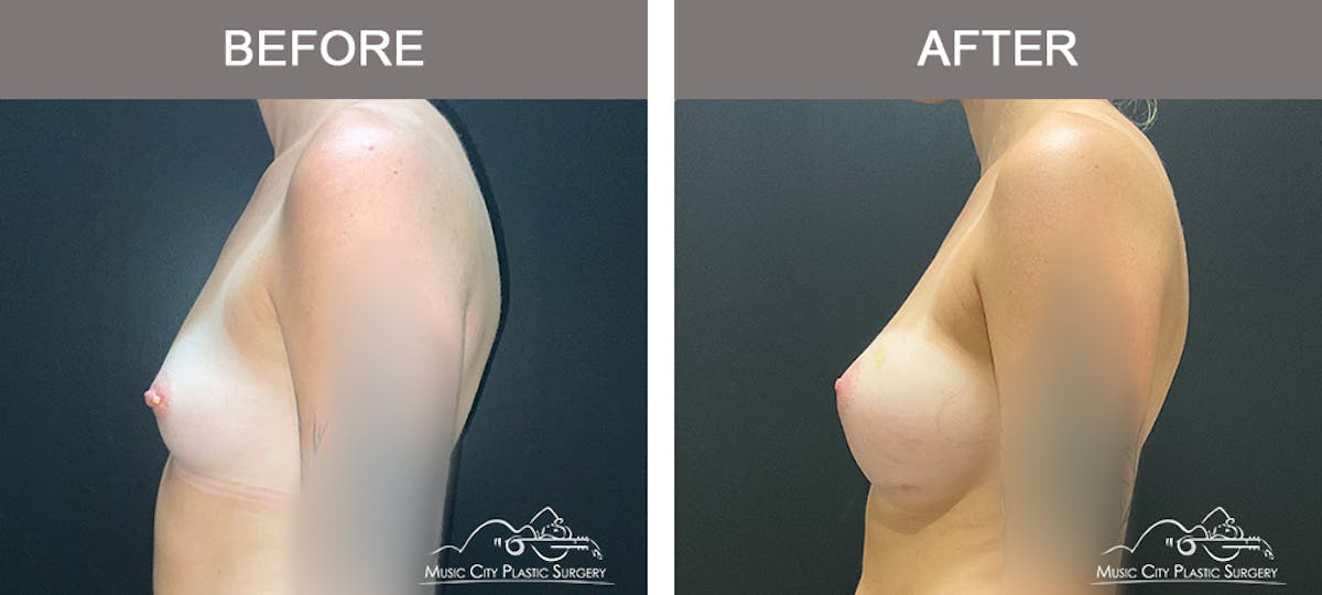 Breast Augmentation Before & After Gallery - Patient 195592423 - Image 5