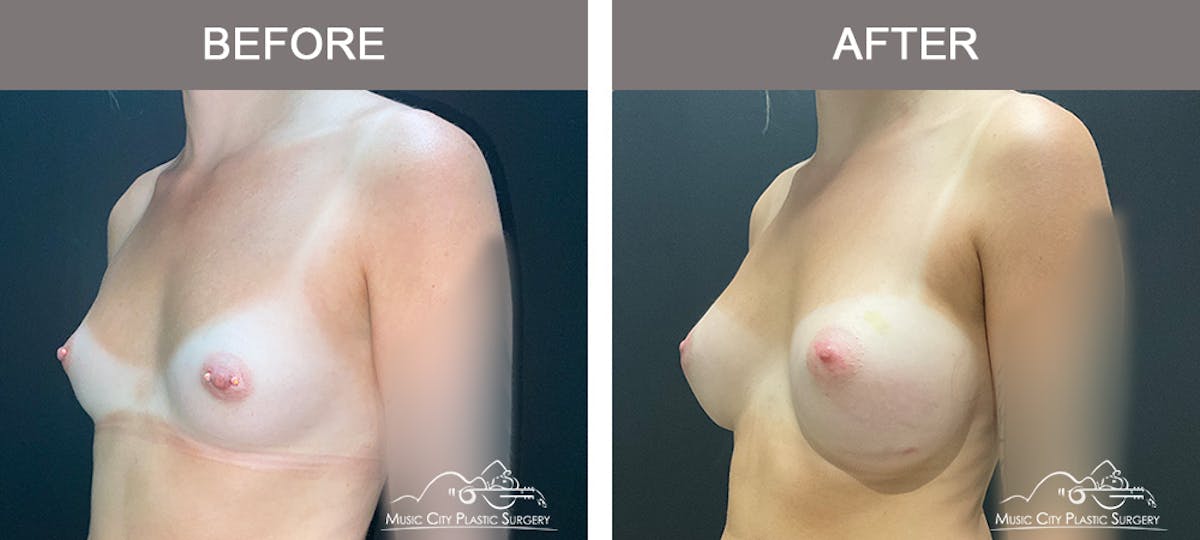 Breast Augmentation Before & After Gallery - Patient 195592423 - Image 4