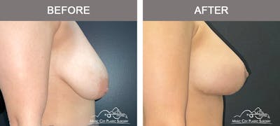 Breast Augmentation Before & After Gallery - Patient 195592425 - Image 3