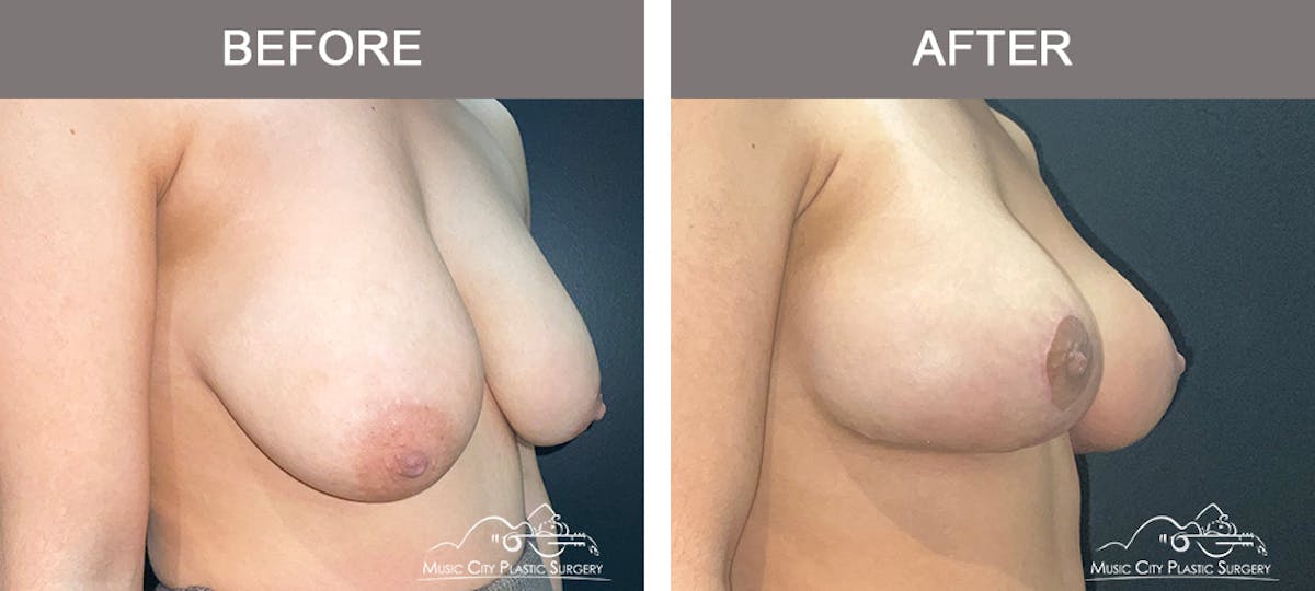 Breast Augmentation Before & After Gallery - Patient 195592425 - Image 2