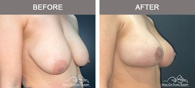 Breast Augmentation Before & After Gallery - Patient 195592425 - Image 2