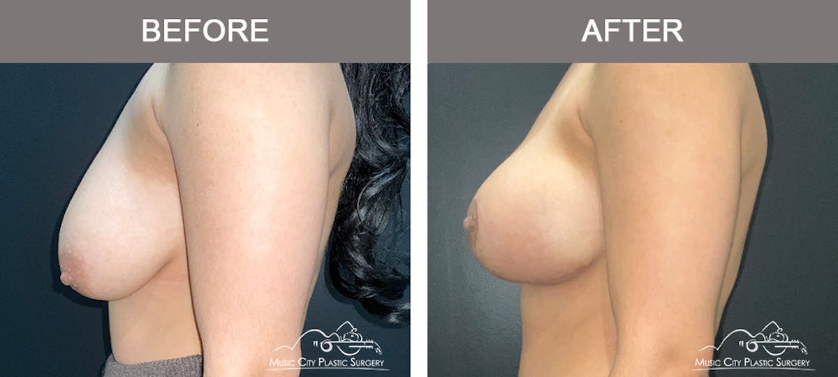 Breast Augmentation Before & After Gallery - Patient 195592425 - Image 5