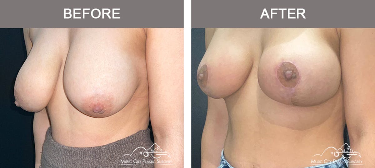 Breast Augmentation Before & After Gallery - Patient 195592425 - Image 4