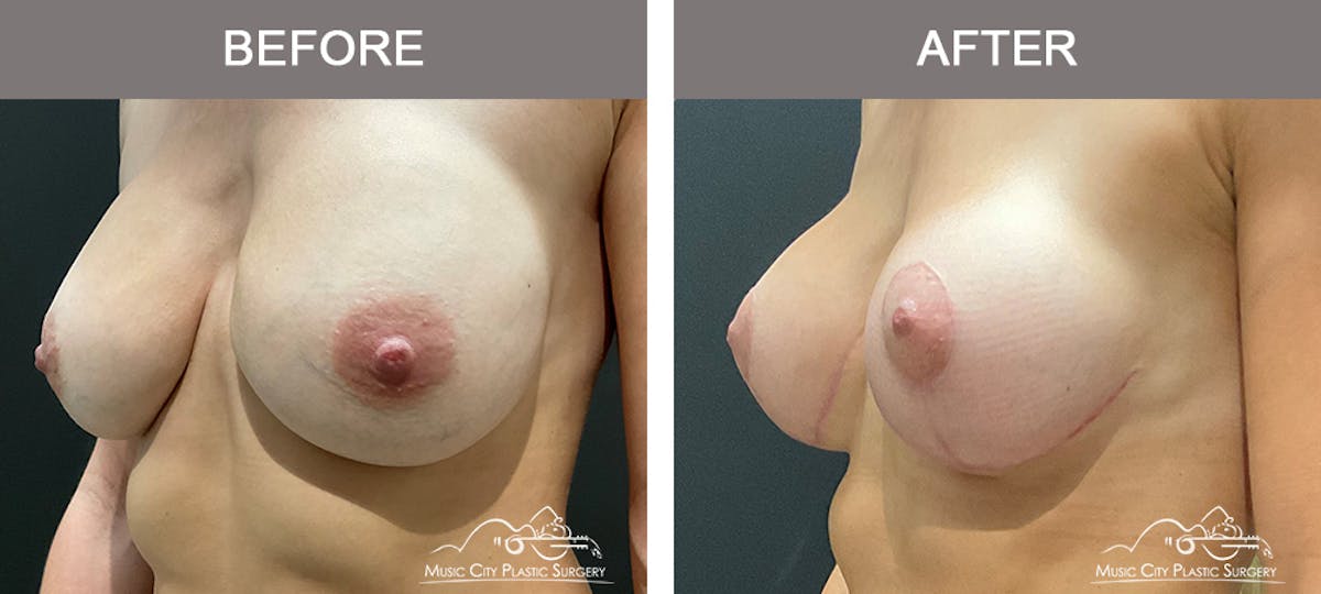 Implant Exchange Before & After Gallery - Patient 195592426 - Image 4