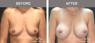 Breast Augmentation Before & After Gallery - Patient 196294427 - Image 1