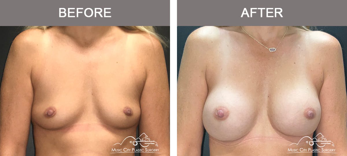 Breast Augmentation Before & After Gallery - Patient 196294427 - Image 1