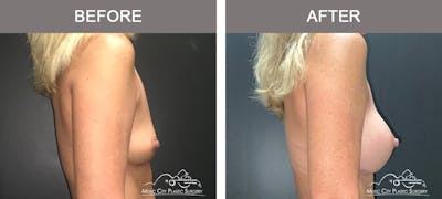 Breast Augmentation Before & After Gallery - Patient 196294427 - Image 3