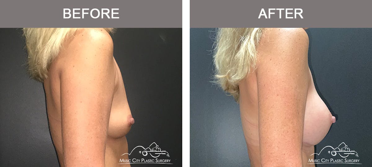 Breast Augmentation Before & After Gallery - Patient 196294427 - Image 3