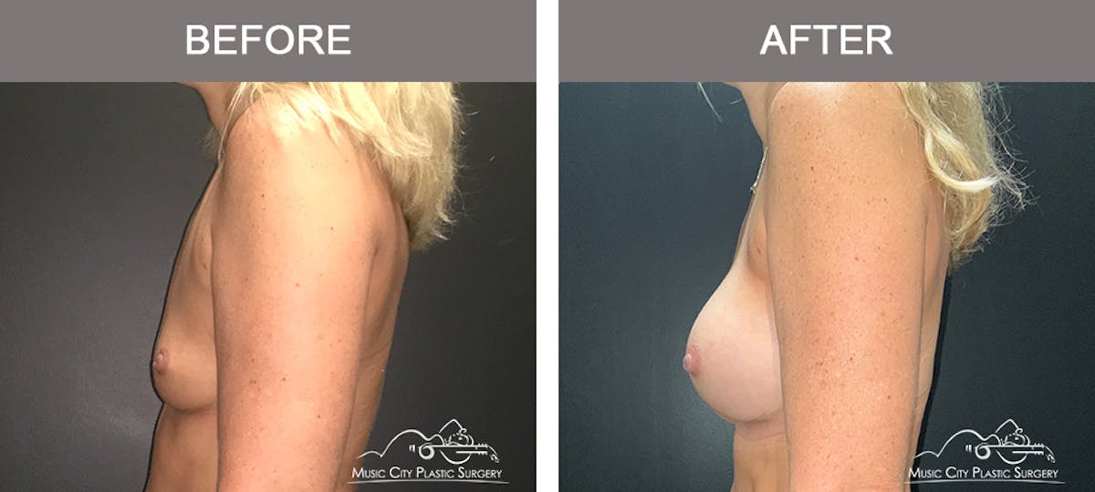 Breast Augmentation Before & After Gallery - Patient 196294427 - Image 5