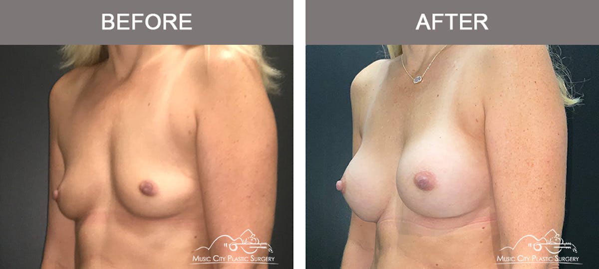 Breast Augmentation Before & After Gallery - Patient 196294427 - Image 4