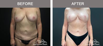 Breast Lift Before & After Gallery - Patient 196294441 - Image 1