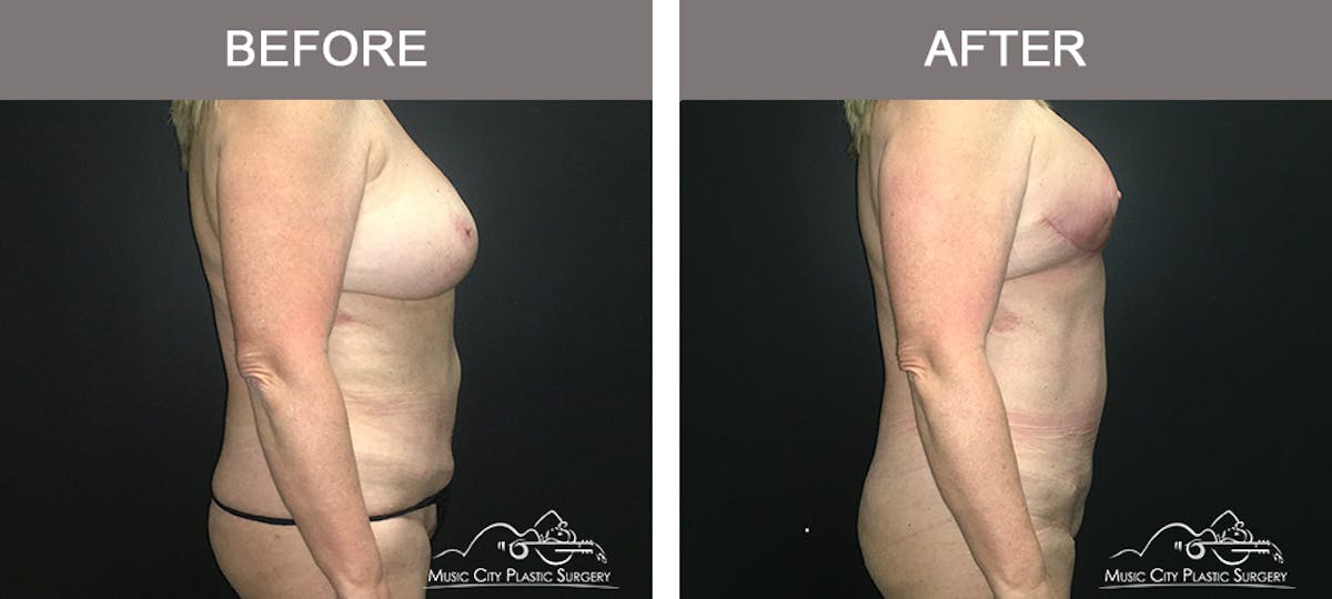 Liposuction Before & After Gallery - Patient 196294436 - Image 3