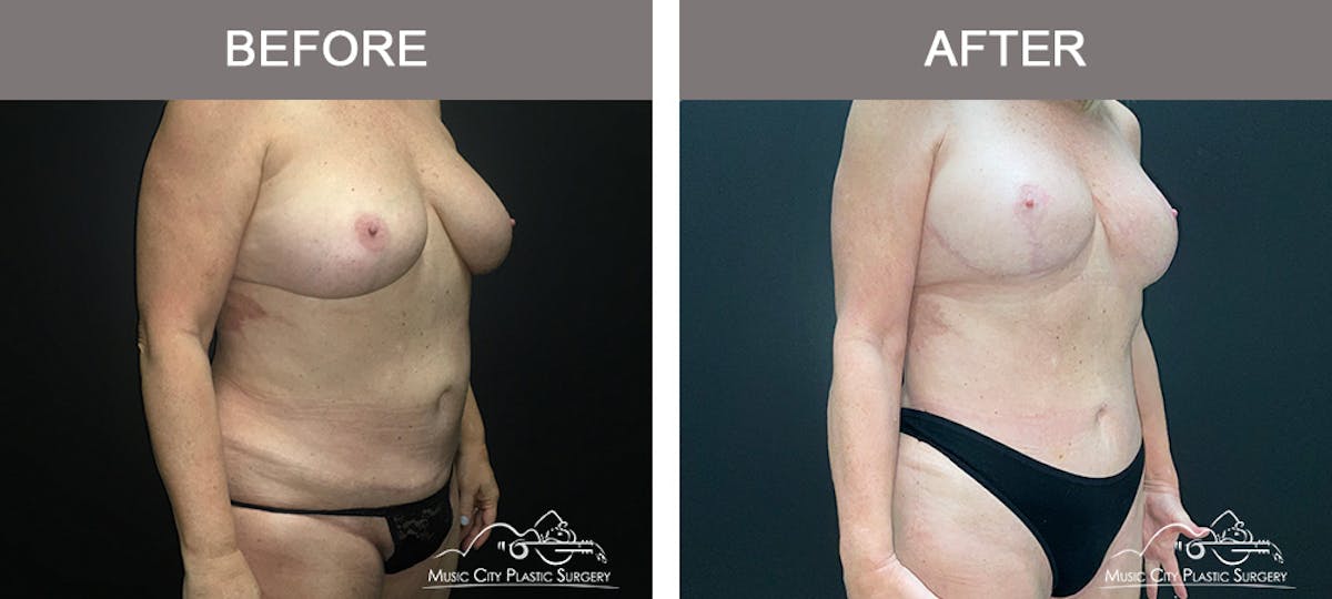 Liposuction Before & After Gallery - Patient 196294436 - Image 2