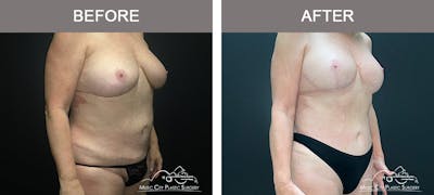 Liposuction Before & After Gallery - Patient 196294436 - Image 2