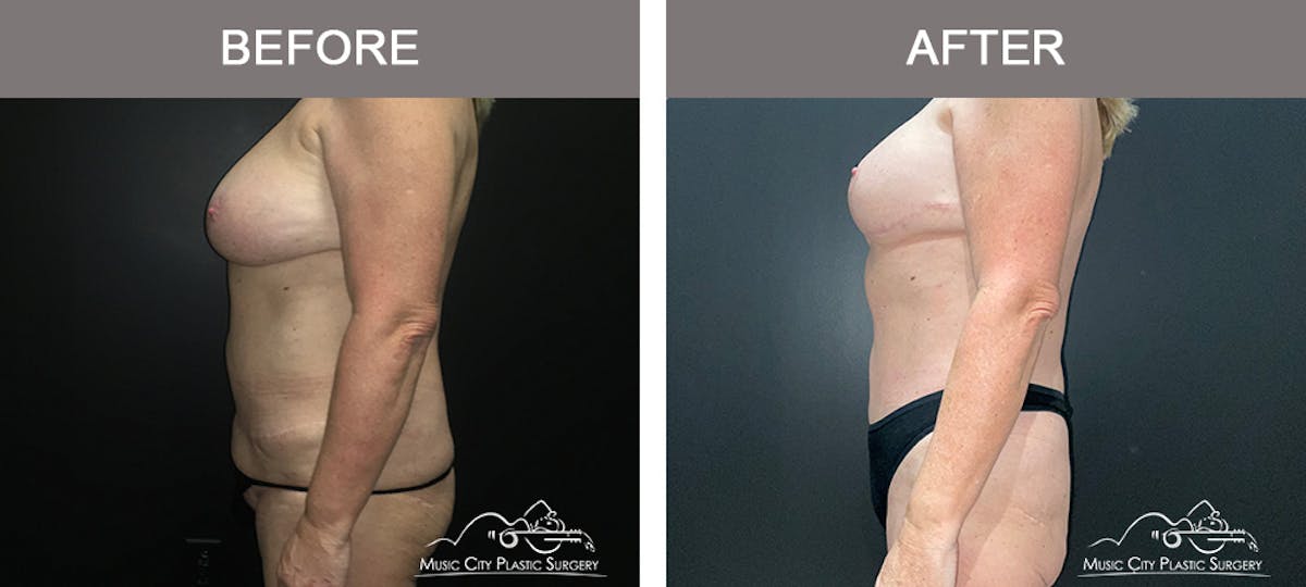Liposuction Before & After Gallery - Patient 196294436 - Image 5