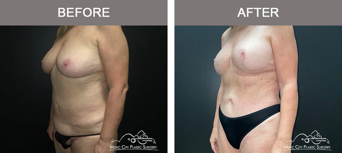 Breast Lift Before & After Gallery - Patient 196294441 - Image 4