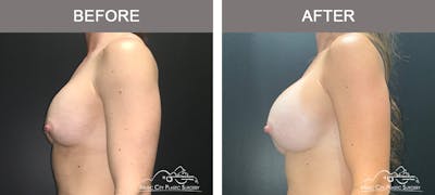 Implant Exchange Before & After Gallery - Patient 196294430 - Image 3