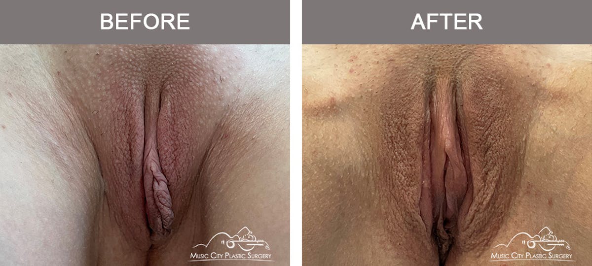 Labiaplasty Before & After Gallery - Patient 196294434 - Image 1