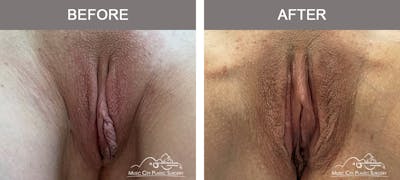 Labiaplasty Before & After Gallery - Patient 196294434 - Image 1