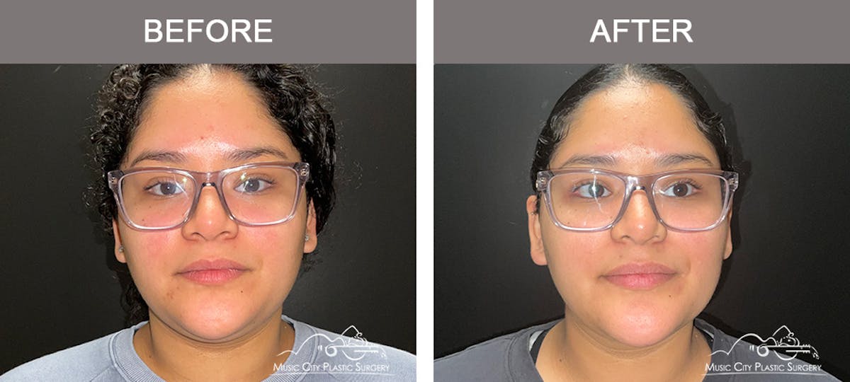 Facial Liposuction Before & After Gallery - Patient 202206 - Image 1