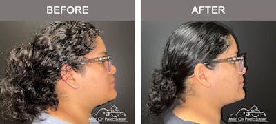 Facial Liposuction Before & After Gallery - Patient 202206 - Image 3