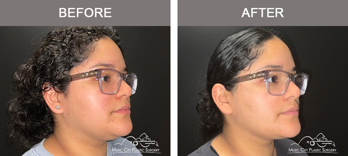 Facial Liposuction Before & After Gallery - Patient 202206 - Image 2