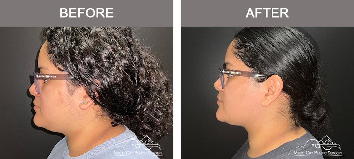 Facial Liposuction Before & After Gallery - Patient 202206 - Image 5