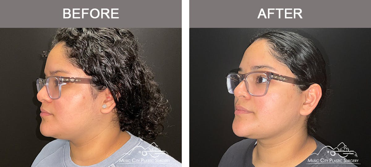 Facial Liposuction Before & After Gallery - Patient 202206 - Image 4