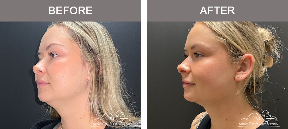 Facial Liposuction Before & After Gallery - Patient 283143 - Image 1