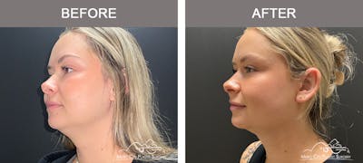 Facial Liposuction Before & After Gallery - Patient 283143 - Image 1