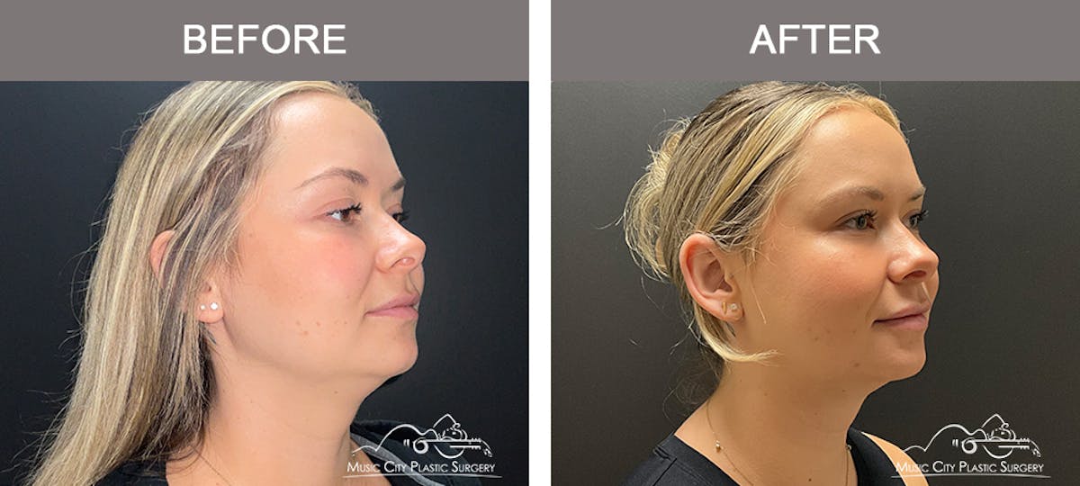 Facial Liposuction Before & After Gallery - Patient 283143 - Image 3