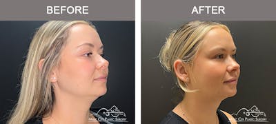 Liposuction Before & After Gallery - Patient 196294438 - Image 3