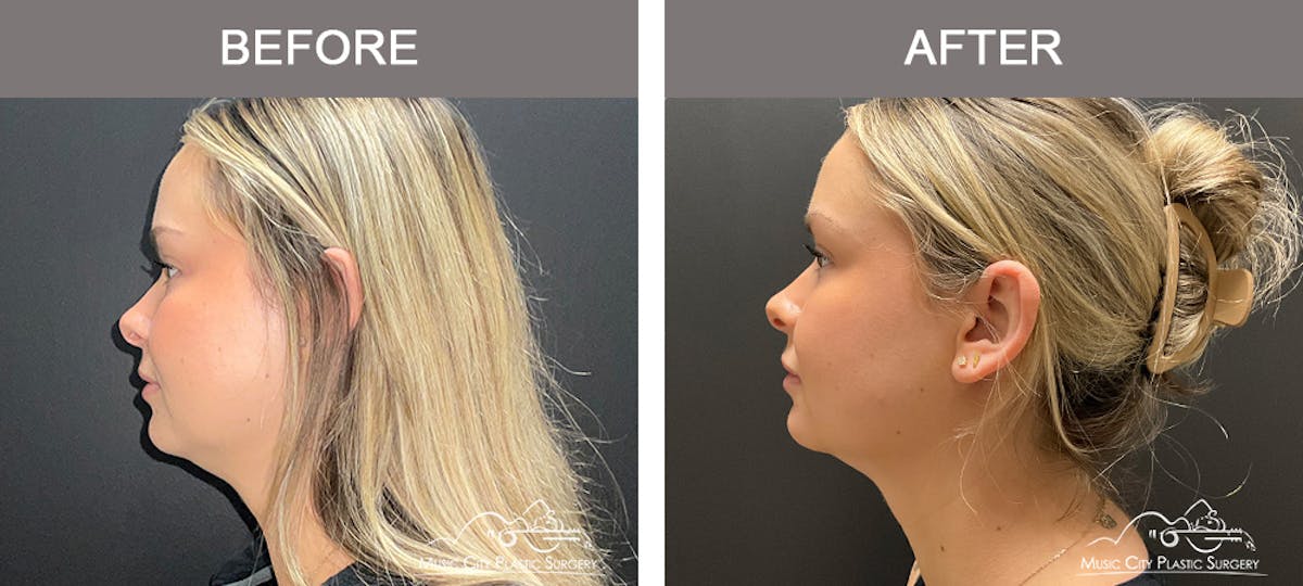 Facial Liposuction Before & After Gallery - Patient 283143 - Image 2