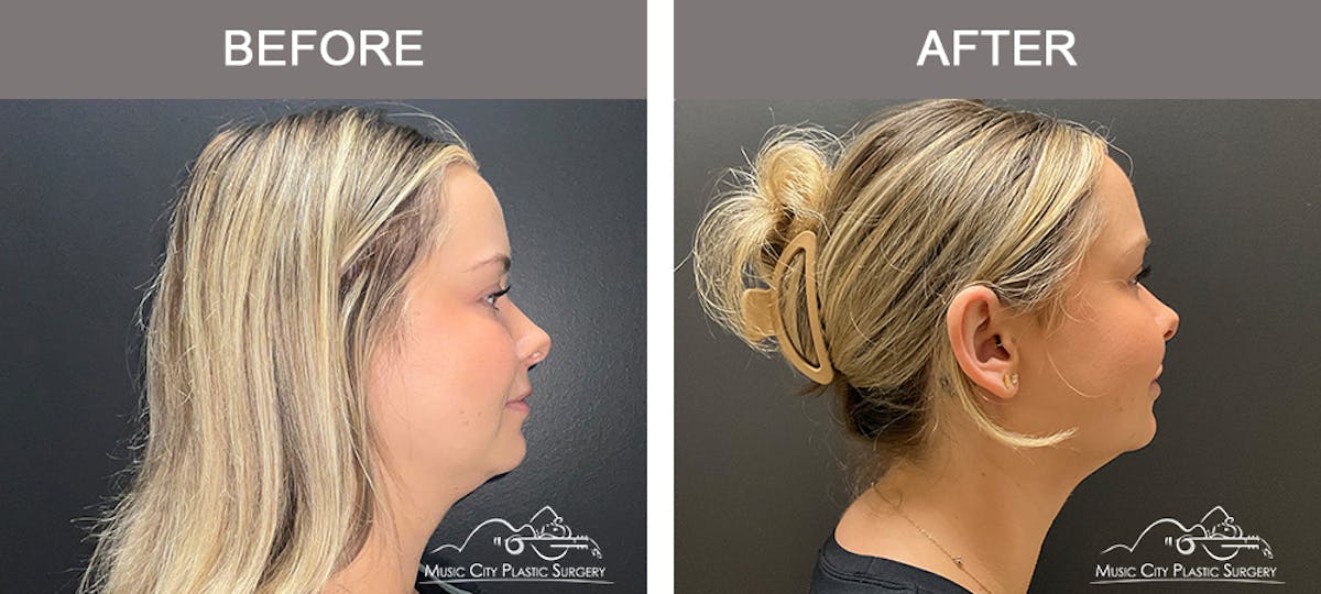 Facial Liposuction Before & After Gallery - Patient 283143 - Image 4