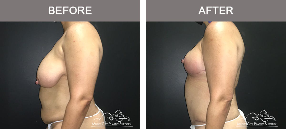 Breast Lift Before & After Gallery - Patient 196294440 - Image 5