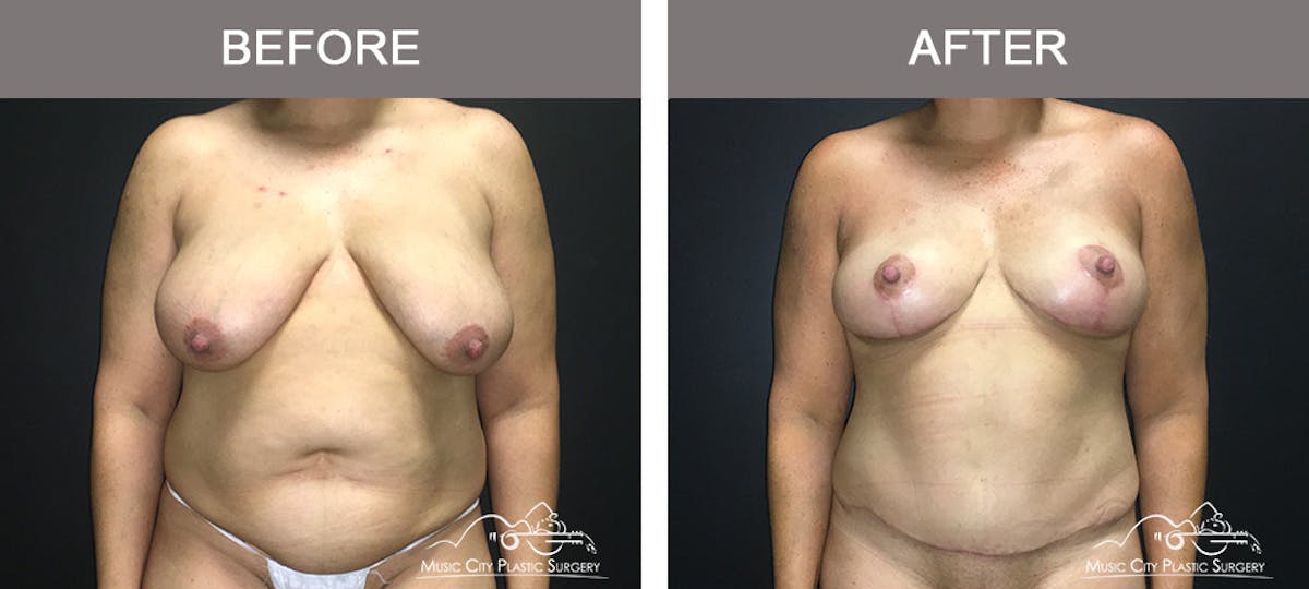 Breast Lift Before & After Gallery - Patient 196294440 - Image 1