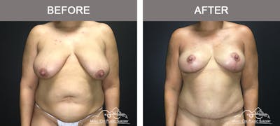 Breast Lift Before & After Gallery - Patient 196294440 - Image 1