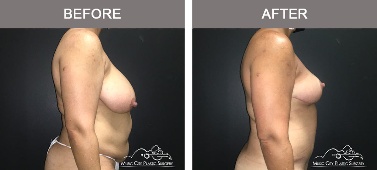 Breast Lift Before & After Gallery - Patient 196294440 - Image 3