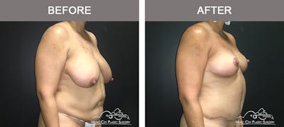 Breast Lift Before & After Gallery - Patient 196294440 - Image 2