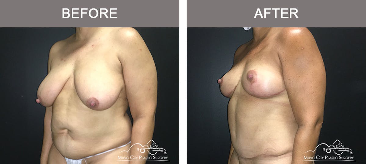 Breast Lift Before & After Gallery - Patient 196294440 - Image 4