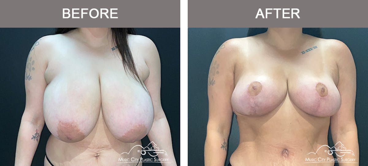 Breast Lift Before & After Gallery - Patient 196294443 - Image 1