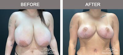 Breast Lift Before & After Gallery - Patient 196294443 - Image 1