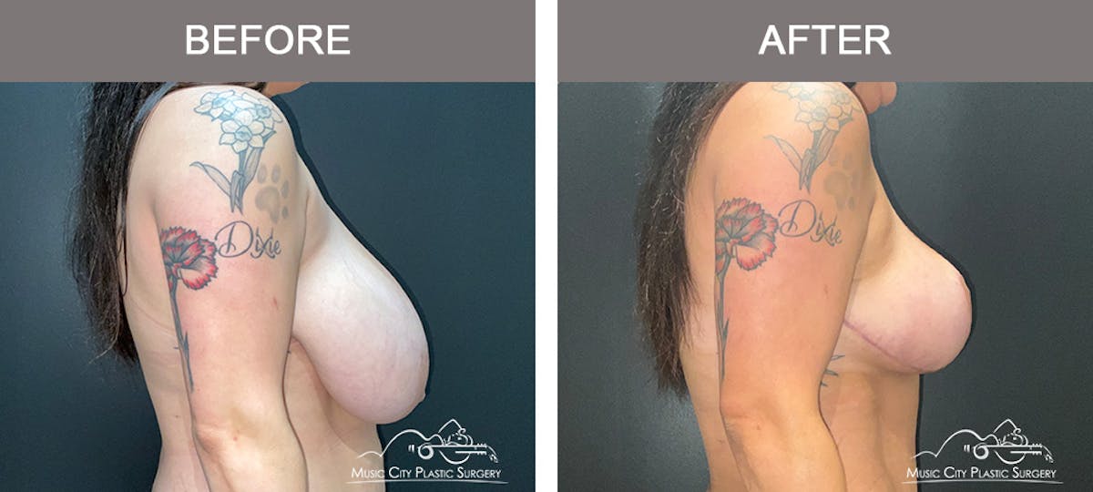 Breast Lift Before & After Gallery - Patient 196294443 - Image 3